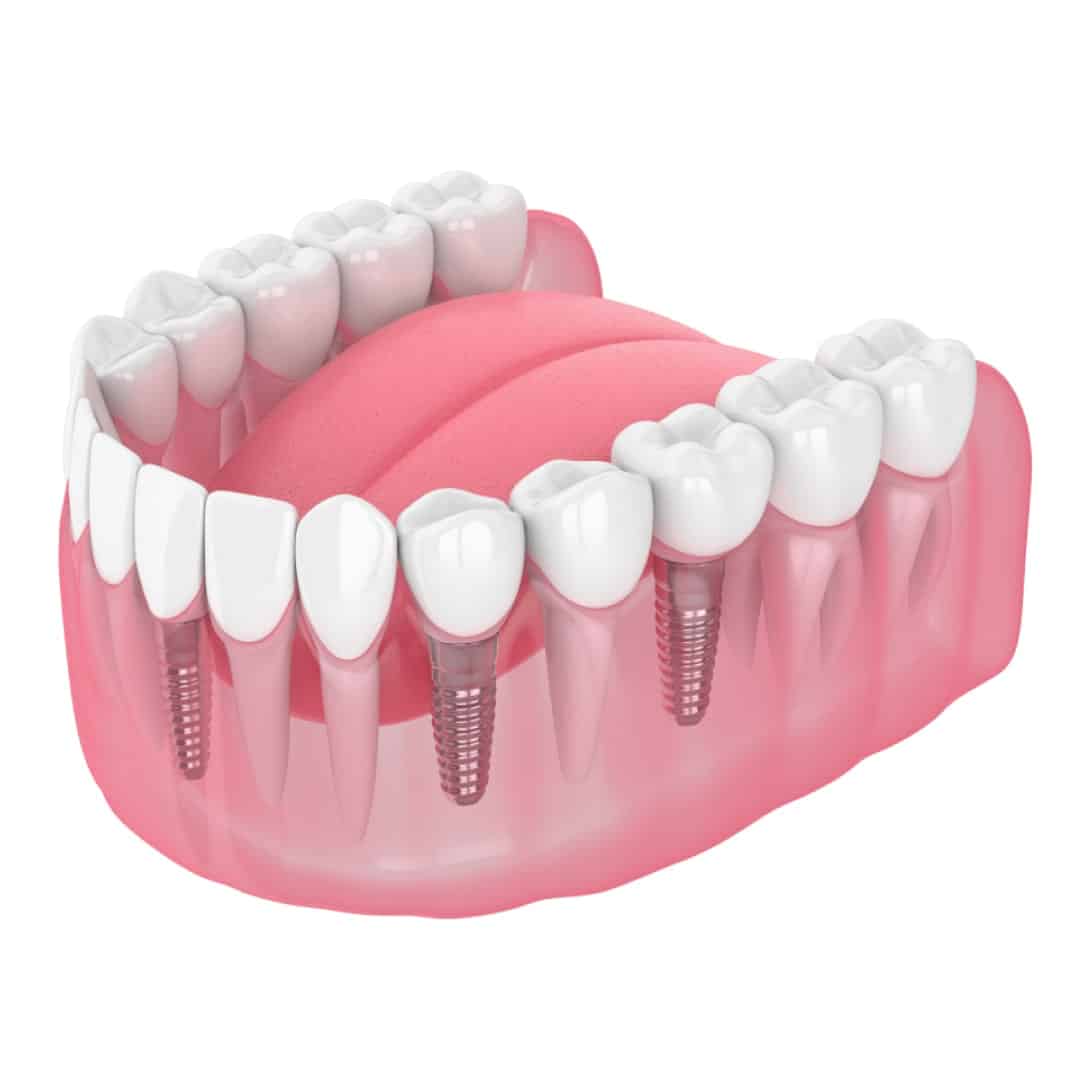 Multiple Dental Implant