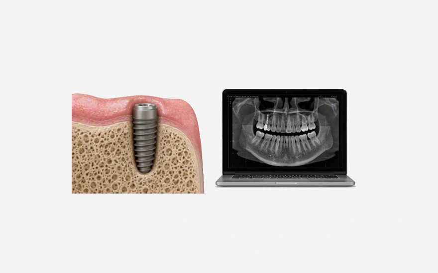 Bone and Gum Assesment for Multiple Tooth Implants