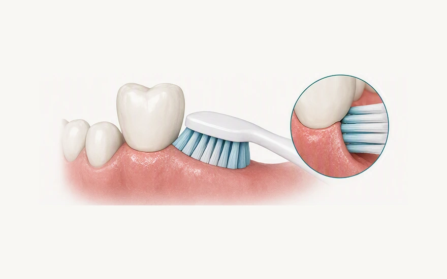 Cleaning and Managing Dental Implants