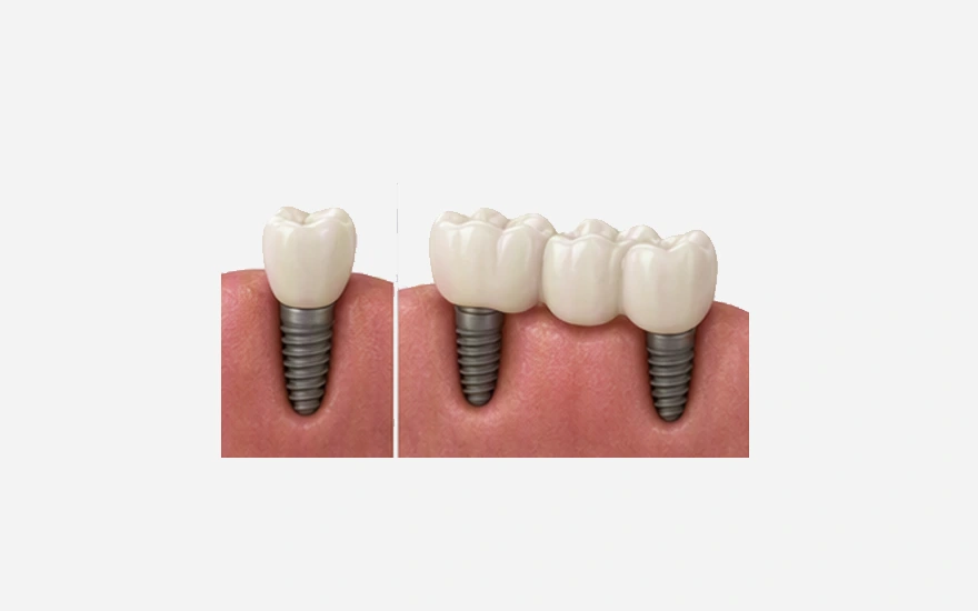 Fixed Crowns vs Bridge - Pros and Cons for Multiple Dental Implants