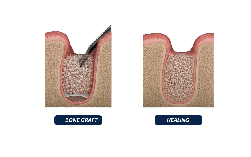 Healing After Bone Grafting