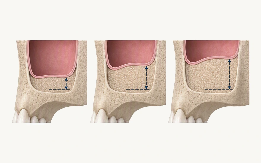 How Much Sinus Lift is Needed to Place an Implant?