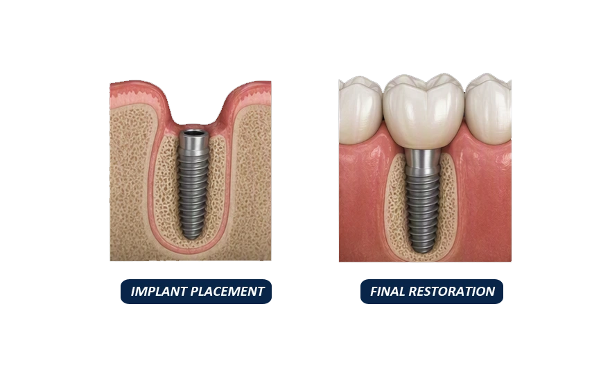 Implant Placement and Final Restoration After Bone Grafting