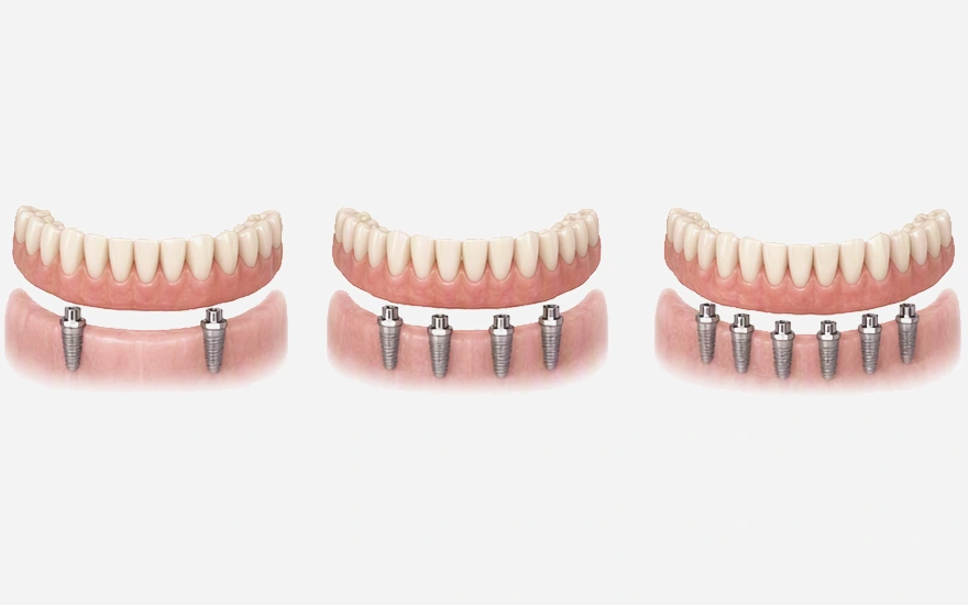 How many implants a case needs