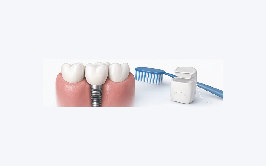 Long Term Care After Implants Treatment