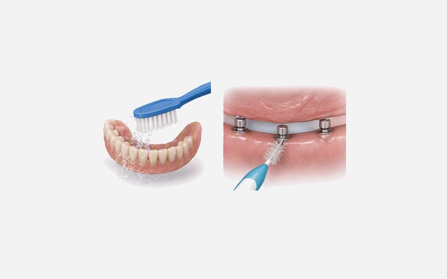 Implant-supported dentures still need daily cleaning