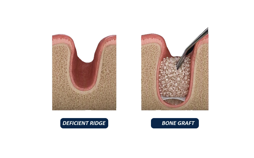 Material Options for Bone Grafting