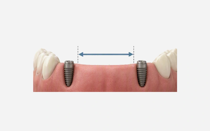 Multiple Tooth Implants in White Rock, BC