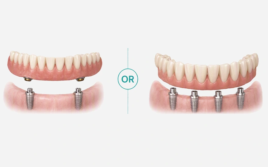 Removable overdenture or something fixed?