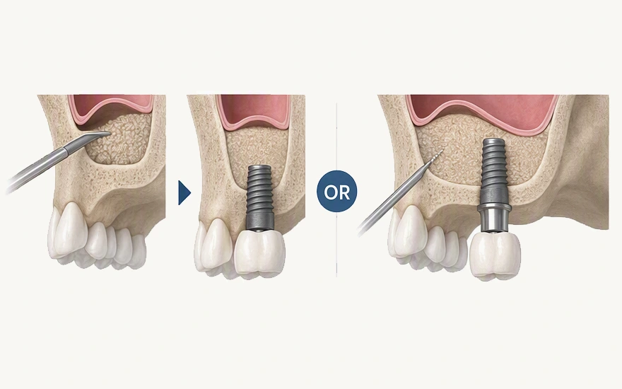 Sinus Lift and Implant in One Appointment