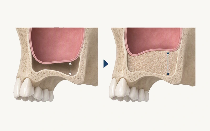 Sinus Lift in White Rock, BC