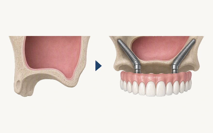 Sinus Lift vs Zygomatic Implant