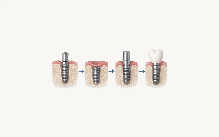 Implant Treatment Step-by-Step