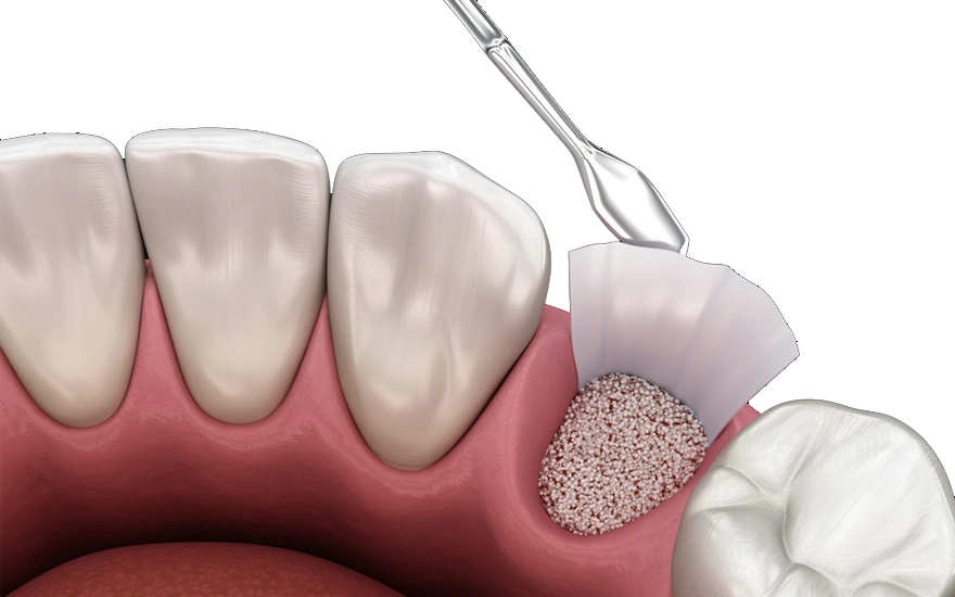 When Bone Grafting is Actually Recommended?