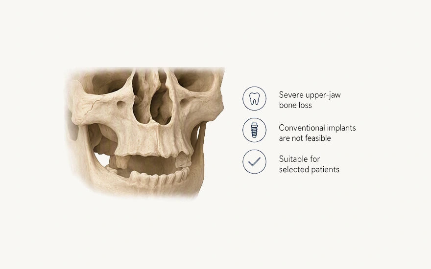 When to Choose Zygomatic Implants