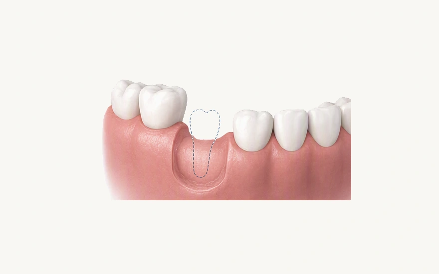 Why Choose Dental Implants as a Treatment Option.