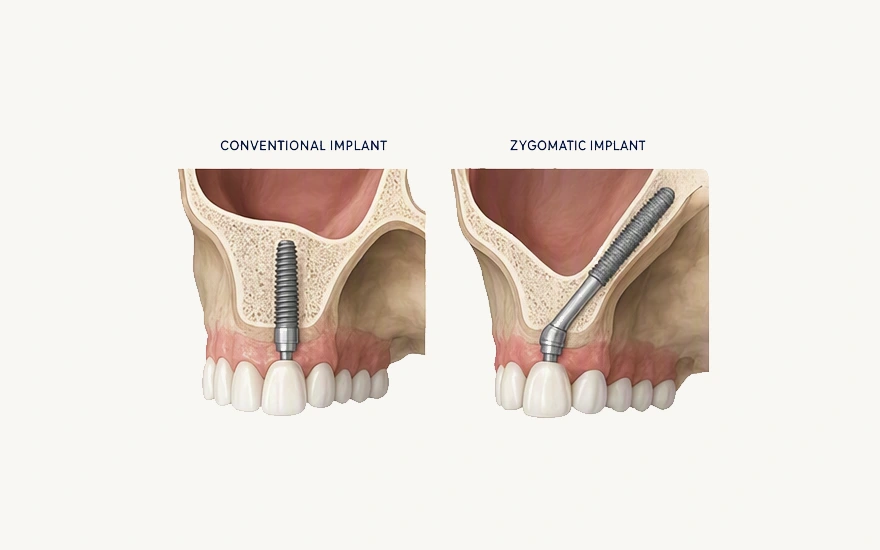 Zygomatic Implants in White Rock, BC