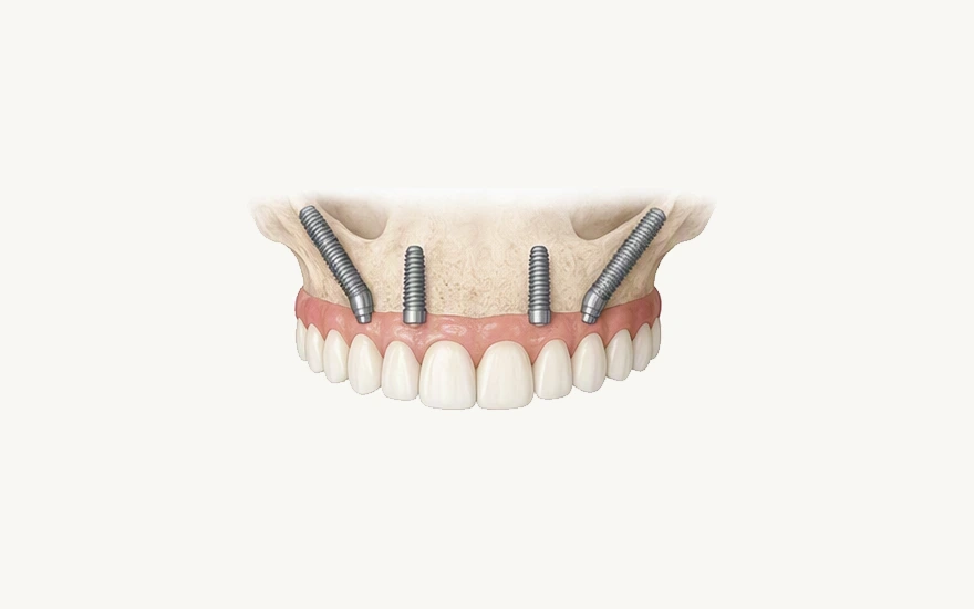 Zygomatic implants are considered within a broader full-arch rehabilitation